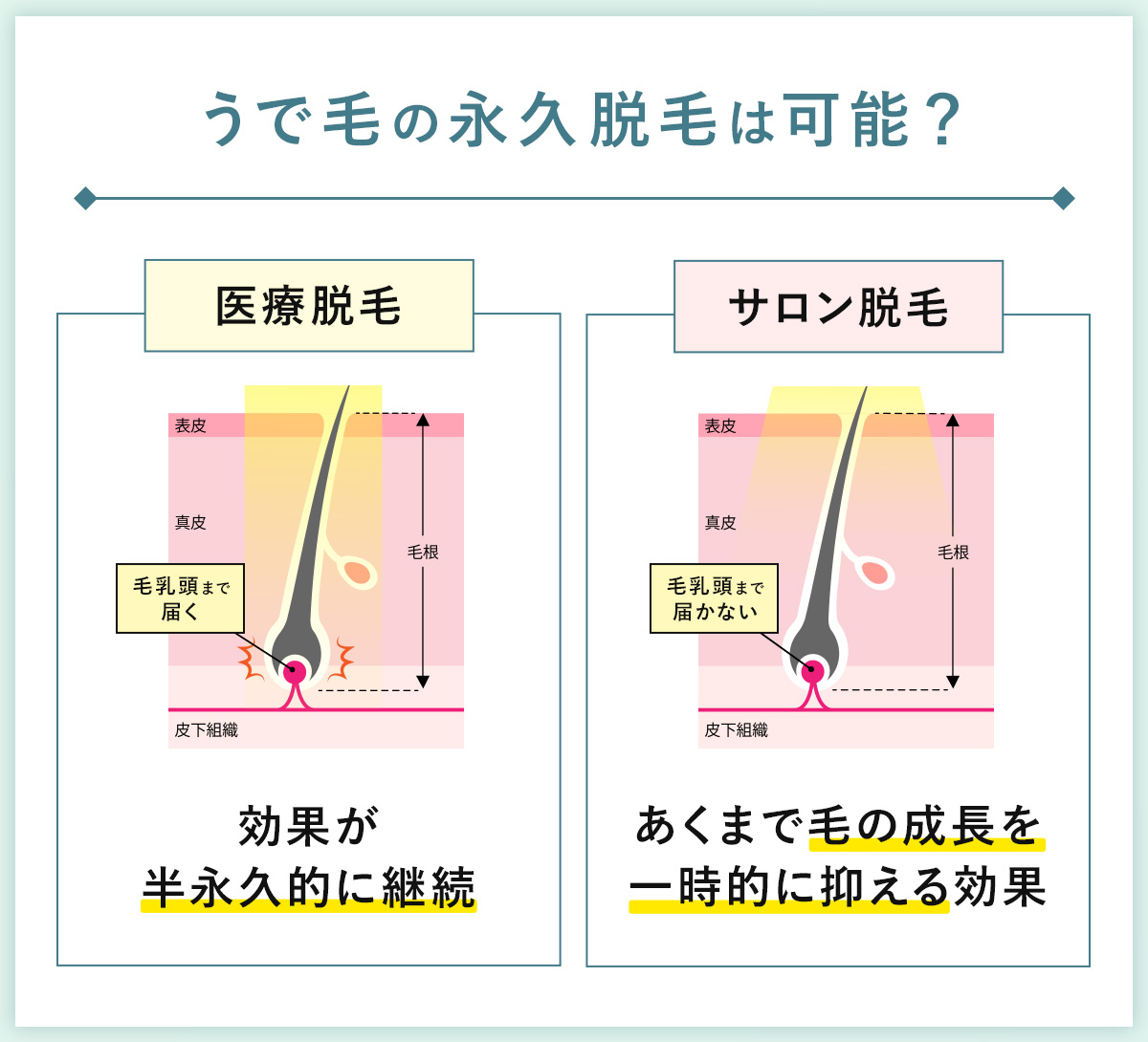 04_うで毛の永久脱毛は可能？