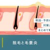 67_脱毛_毛嚢炎