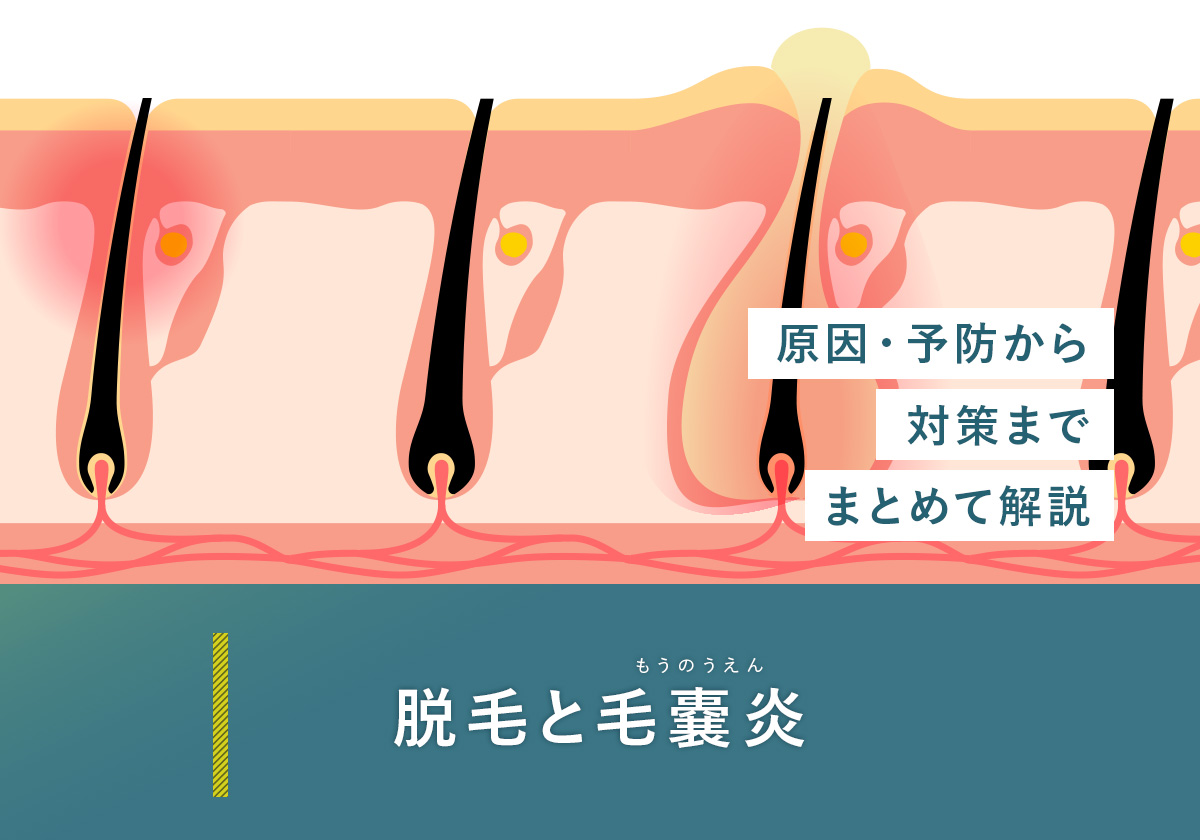 67_脱毛_毛嚢炎
