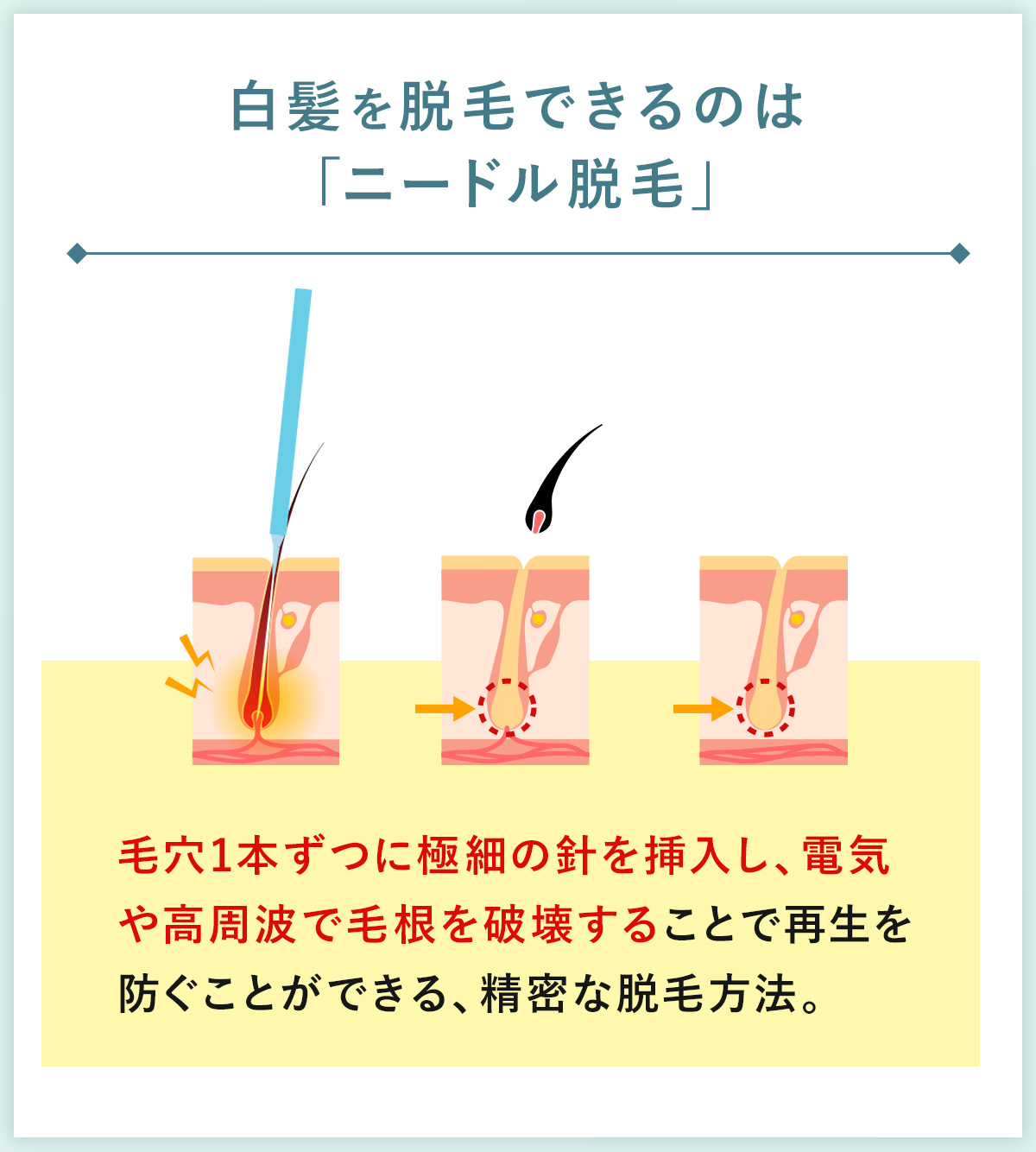 02_白髪を脱毛できるのは「ニードル脱毛」