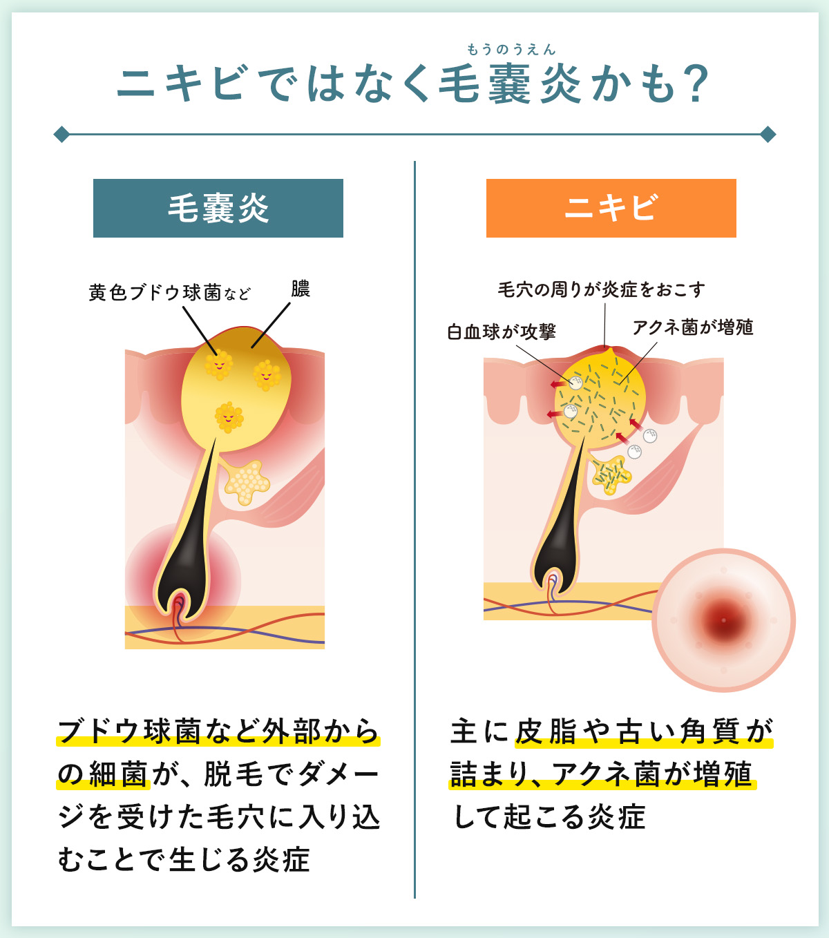 03_ニキビではなく毛嚢炎かも?