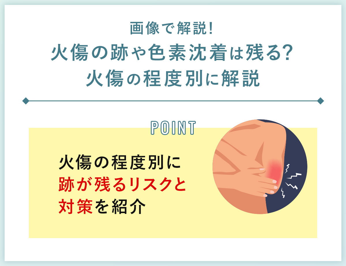 06_画像で解説!火傷の跡や色素沈着は残る?火傷の程度別に解説