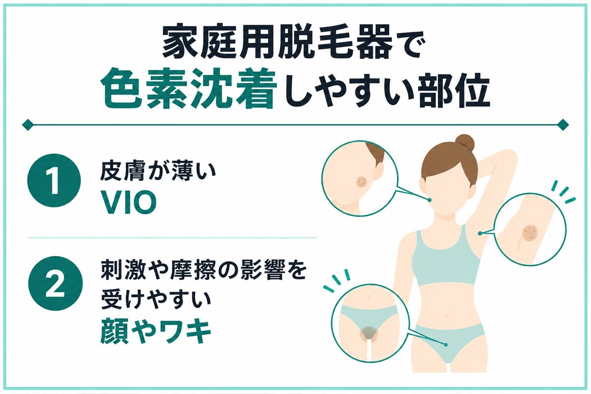 家庭用脱毛器で色素沈着しやすい部位