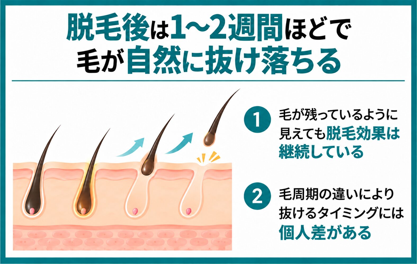 脱毛後は1〜2週間ほどで毛が自然に抜け落ちる